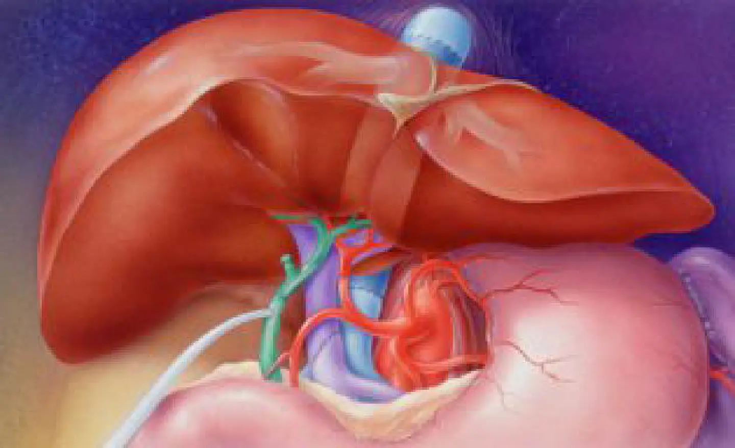 Acute liver failure in chronic liver disease Acute liver failure in chronic liver disease