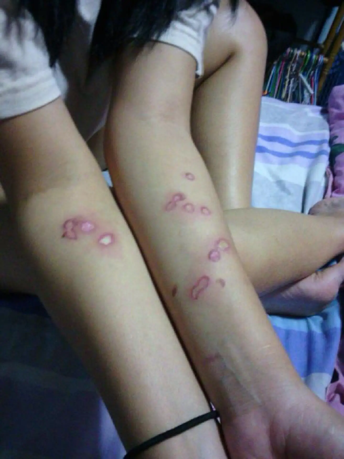 Varsity to probe claims of burns from candle wax in hazing Varsity to probe claims of burns from candle wax in hazing