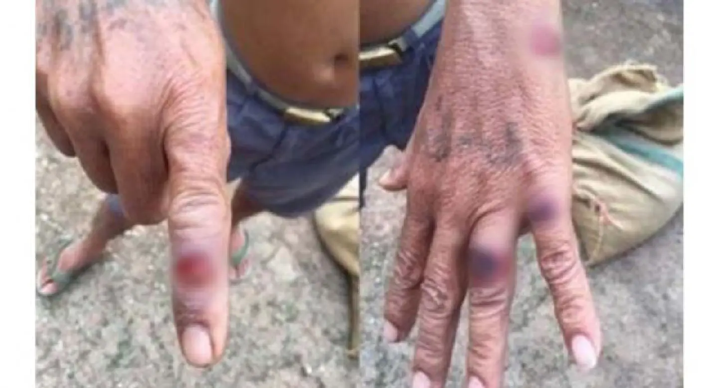 First anthrax infection in 17 years detected