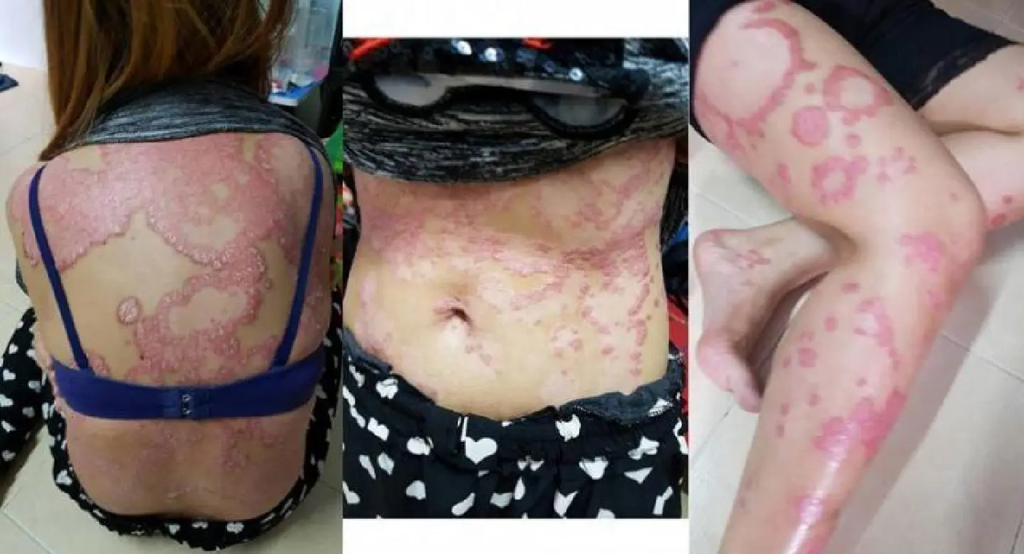 Shunned psoriasis sufferer warmed by rays of hope Shunned psoriasis sufferer warmed by rays of hope