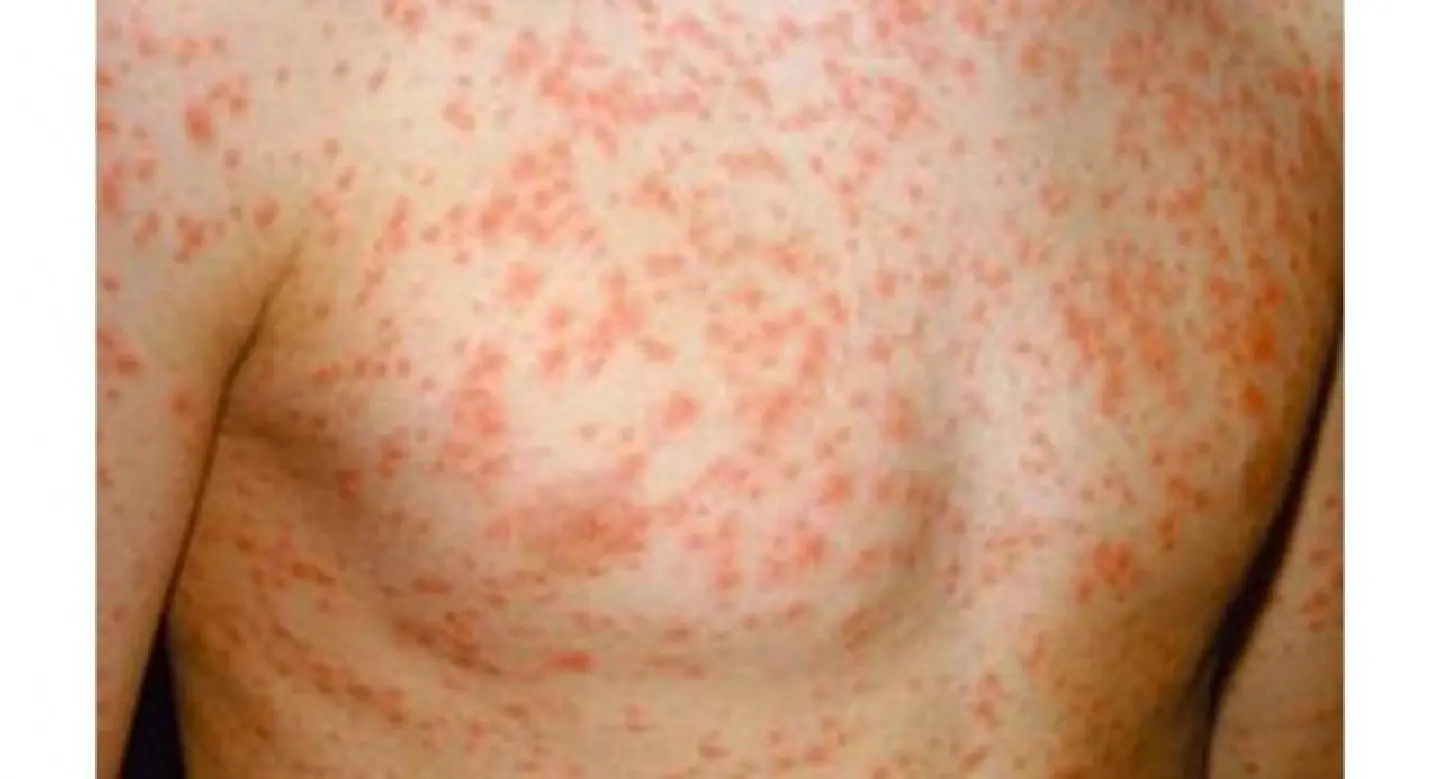 ‘Vaccine denial’ behind measles deaths in South ‘Vaccine denial’ behind measles deaths in South