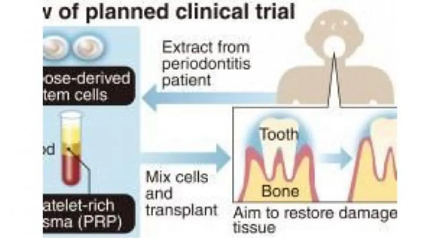 Stem cell treatment could reverse gum disease Stem cell treatment could reverse gum disease