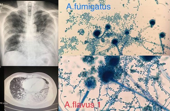 Doctor warns of flu complications Doctor warns of flu complications