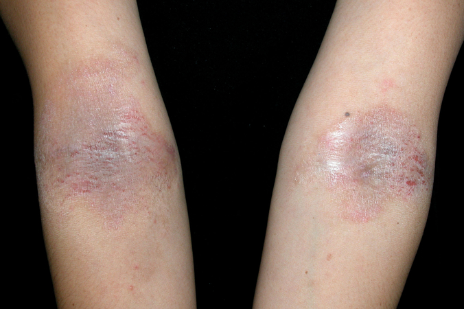 Get help for chronic body rash: dermatology professor Get help for chronic body rash: dermatology professor