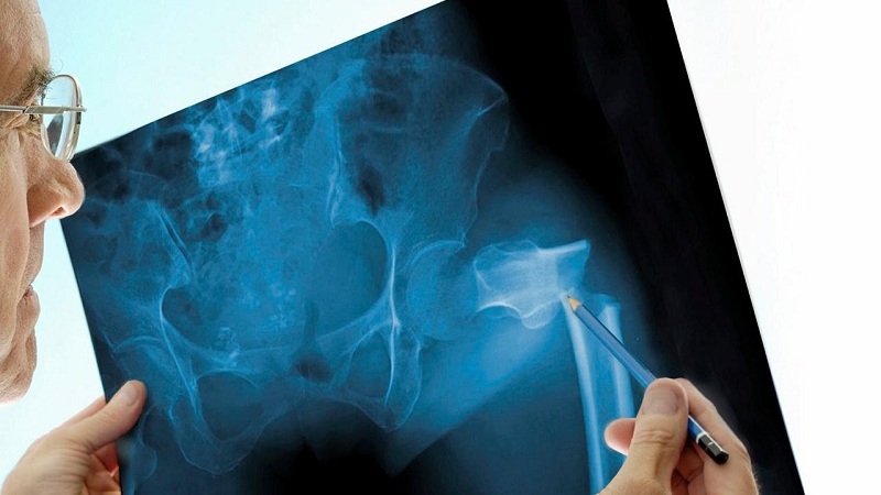 300,000 break their hips each year. Calcium and vitamin D could cut that number, research says. 300,000 break their hips each year. Calcium and vitamin D could cut that number, research says.