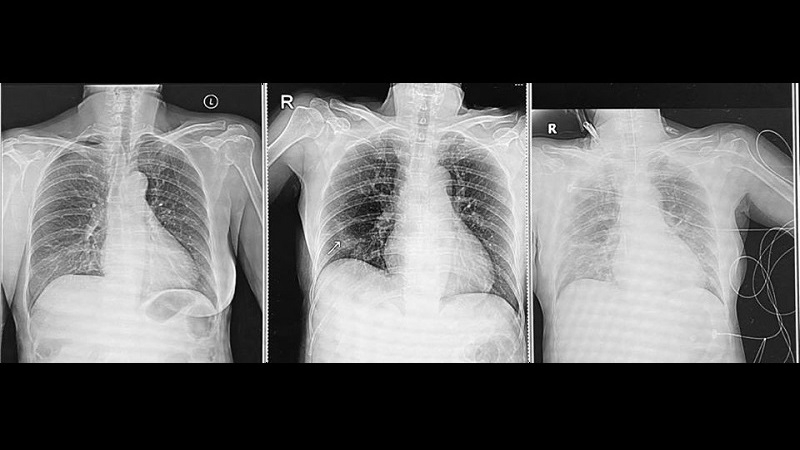 Daughter inadvertently infects her mother with Covid-19 Daughter inadvertently infects her mother with Covid-19