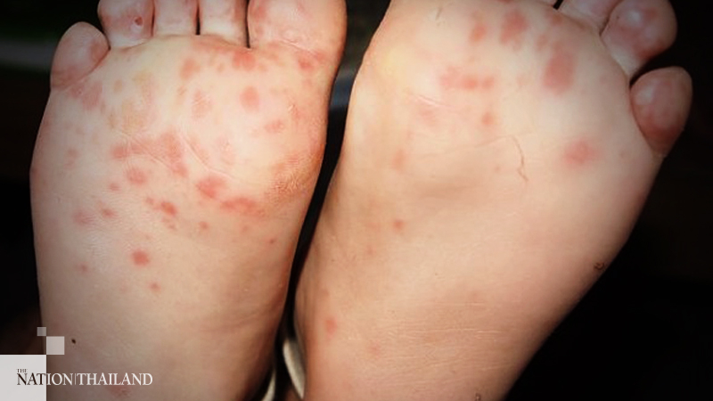 'Frostbite' toes and other peculiar rashes may be signs of hidden coronavirus infection, especially in the young 'Frostbite' toes and other peculiar rashes may be signs of hidden coronavirus infection, especially in the young