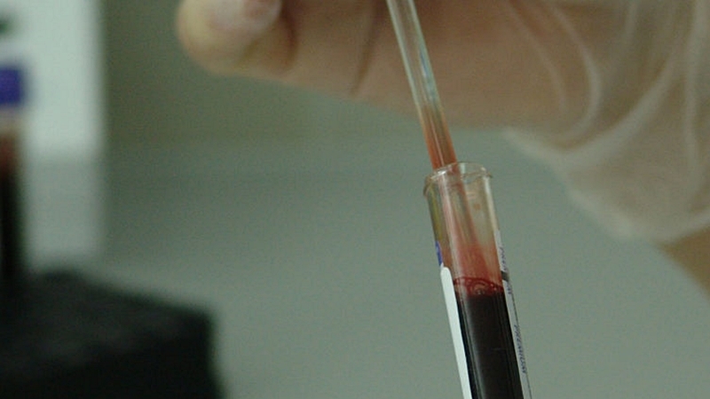 Plasma treatment cures seriously ill Covid-19 patient Plasma treatment cures seriously ill Covid-19 patient