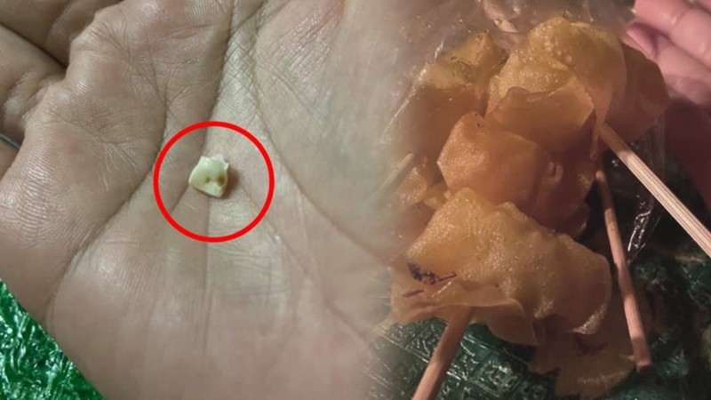 Wonton bites back: ‘Human tooth’ found in fried snack Wonton bites back: ‘Human tooth’ found in fried snack