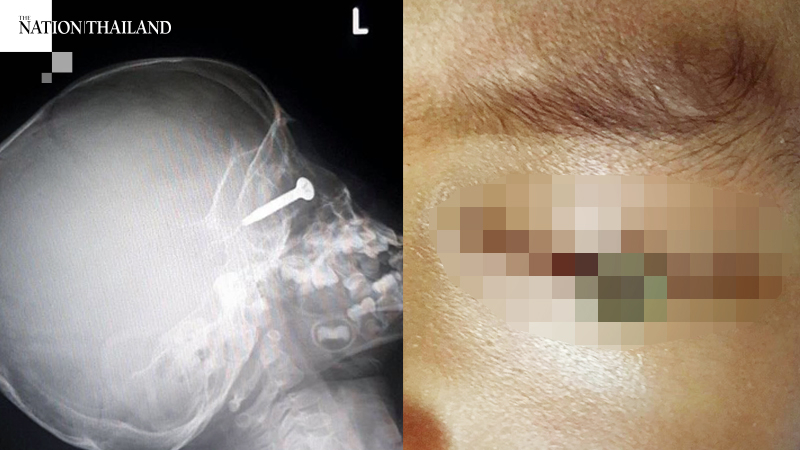 Mower accident leaves nail embedded in child’s eye Mower accident leaves nail embedded in child’s eye