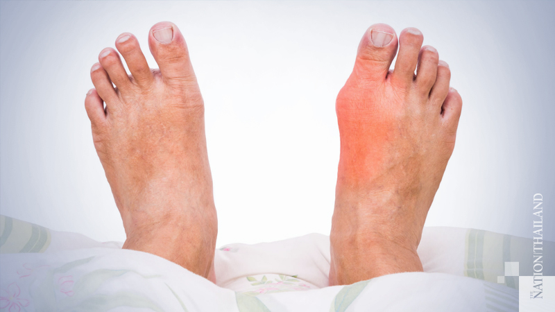 Balanced diet with medicine will help ease gout, advises doctor Balanced diet with medicine will help ease gout, advises doctor
