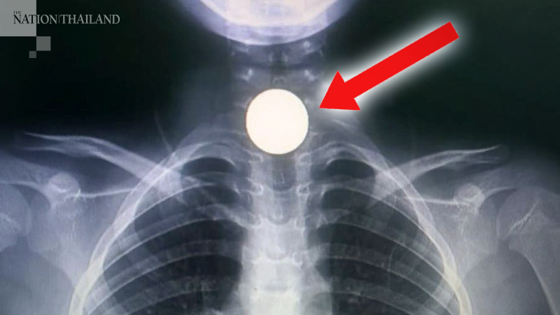 Six-year-old’s dangerous game prompts doctor to warn parents Six-year-old’s dangerous game prompts doctor to warn parents