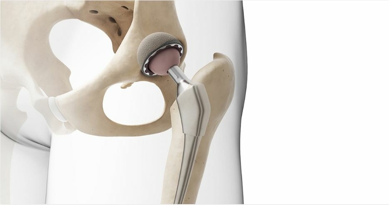 Overview Direct Anterior Approach Total Hip Replacement Overview Direct Anterior Approach Total Hip Replacement
