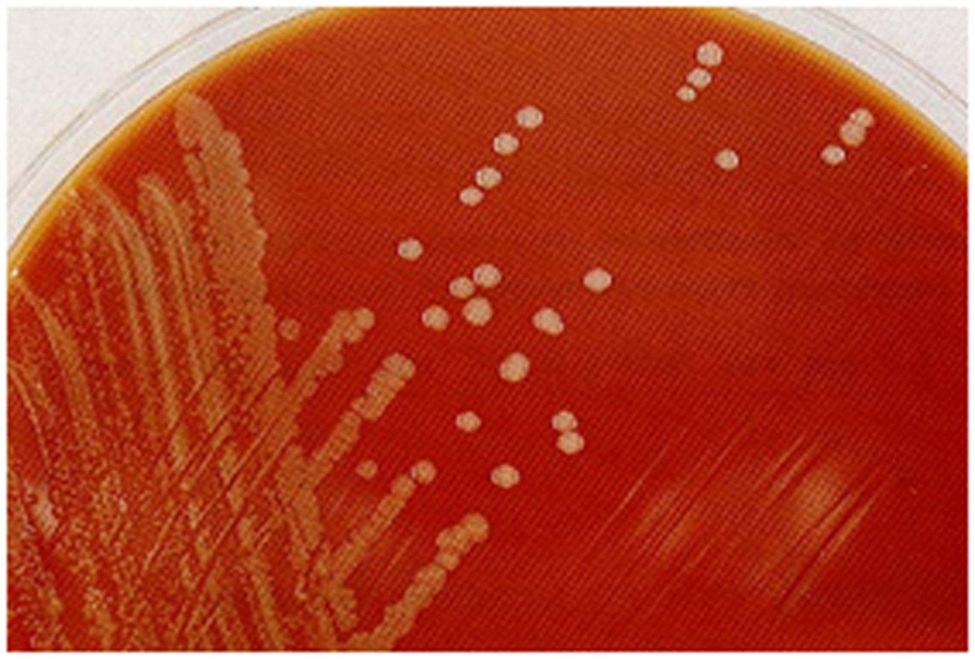 Medicine makes strides in battling meningococcal disease