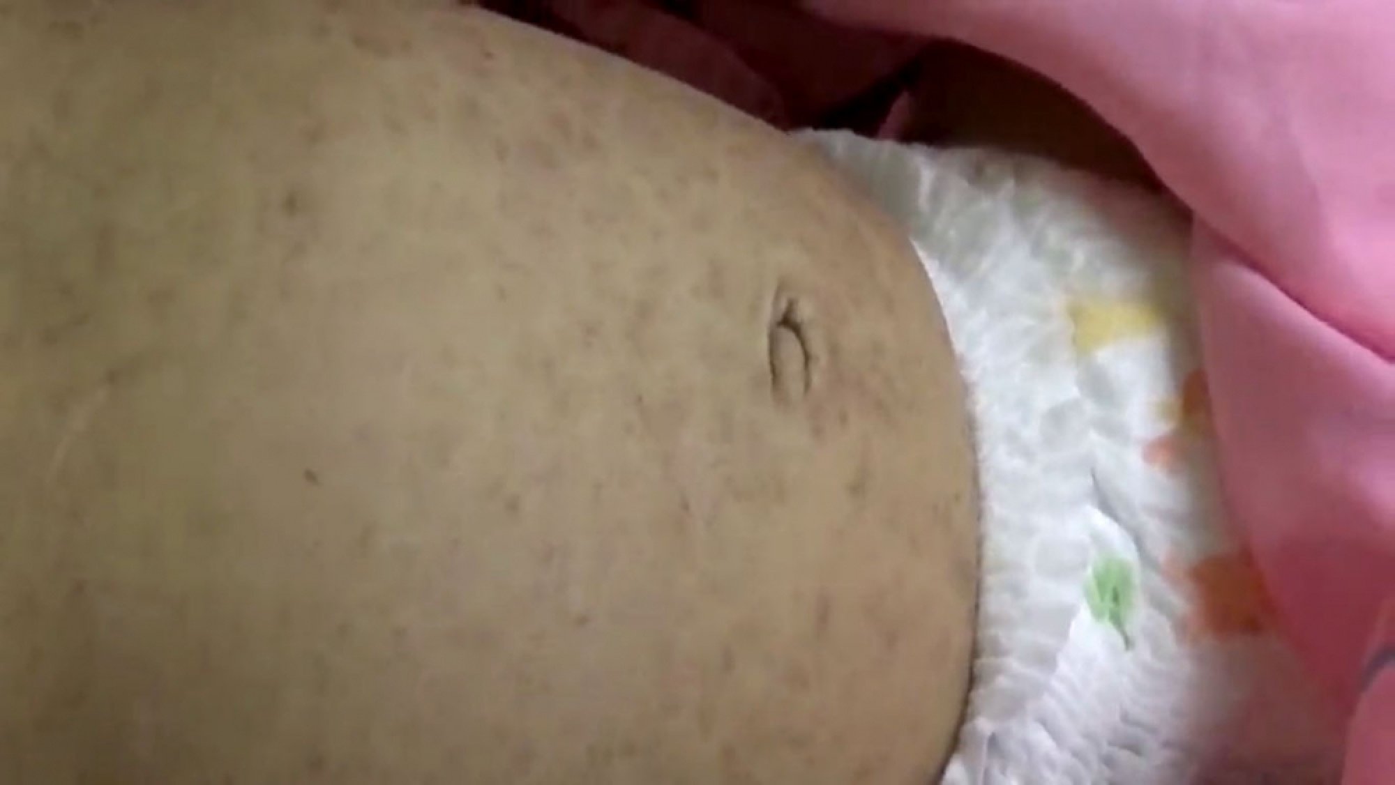Measles kills 18 in South as officials try to fight vaccine denial