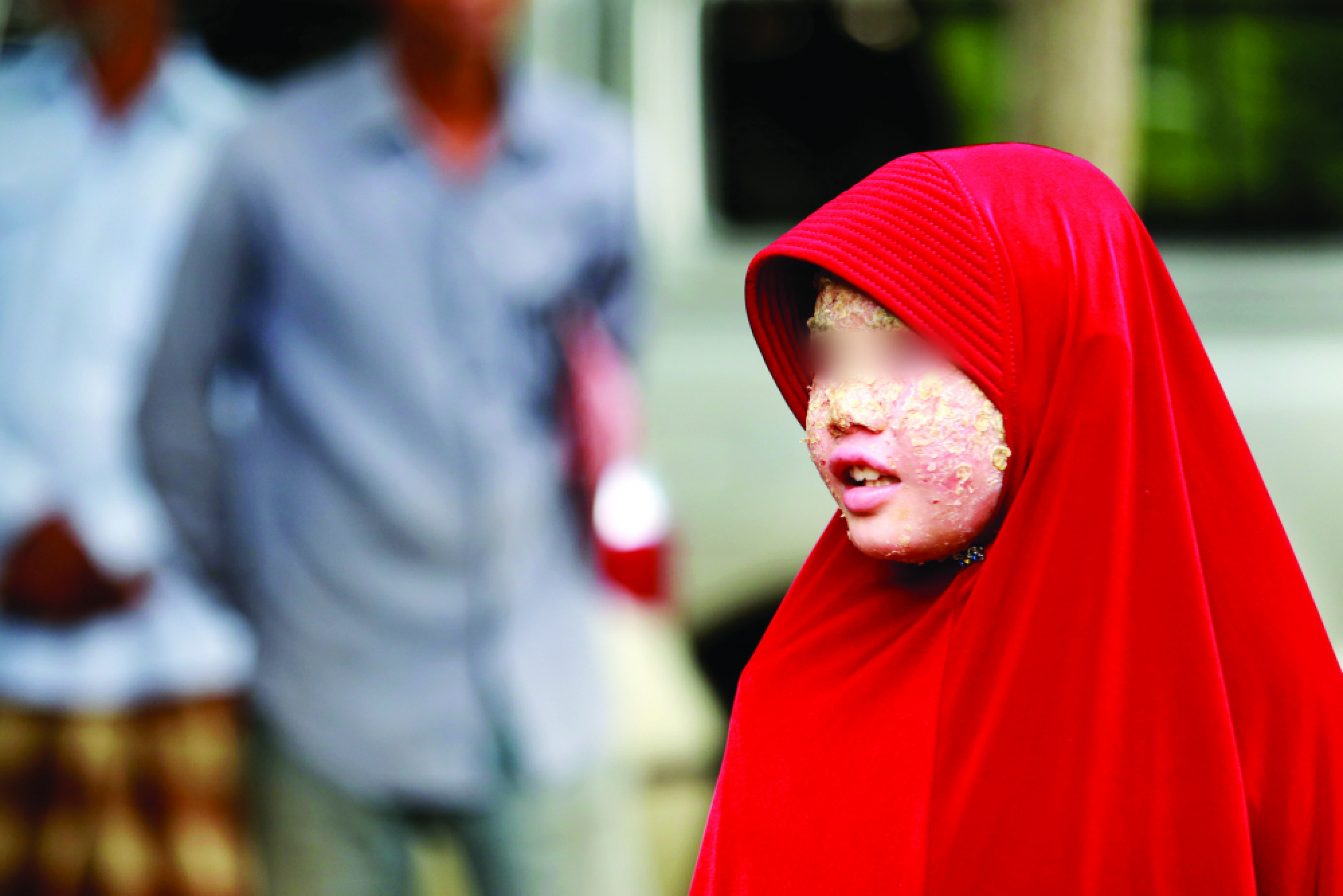 A condition that inflames