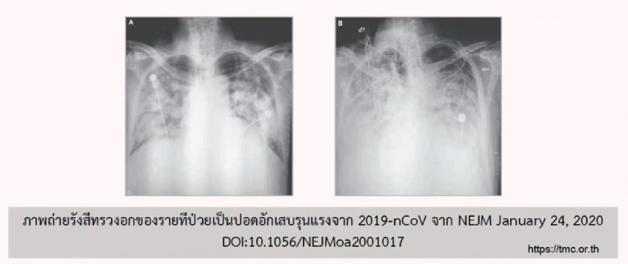 An x-ray flim of new coronavirus infected patient.