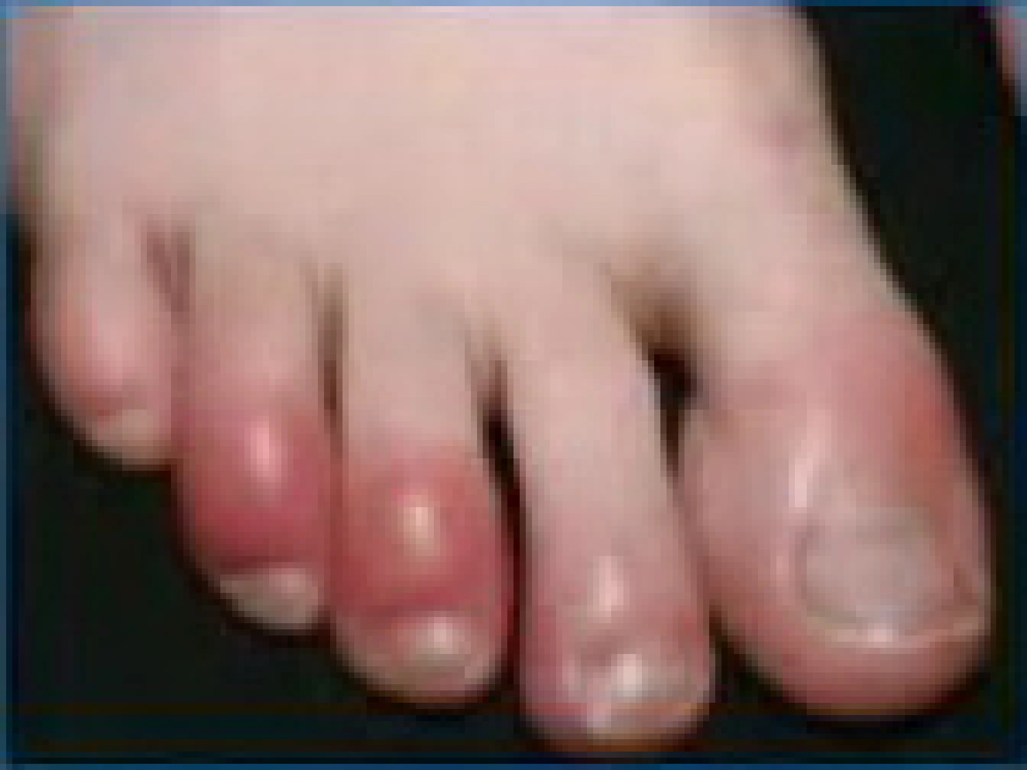Toe skin disease – a Covid-19 symptom?