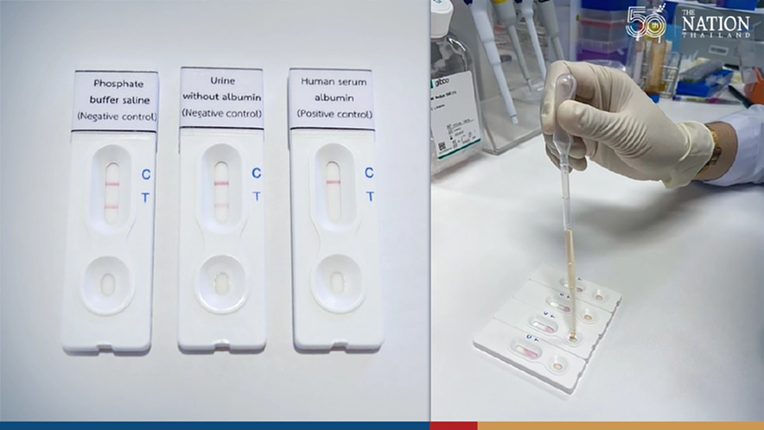 Chronic Kidney Disease is Curable if Detected Early –  Chula’s User-friendly CKD Screening Strips with Results in 15 minutes!