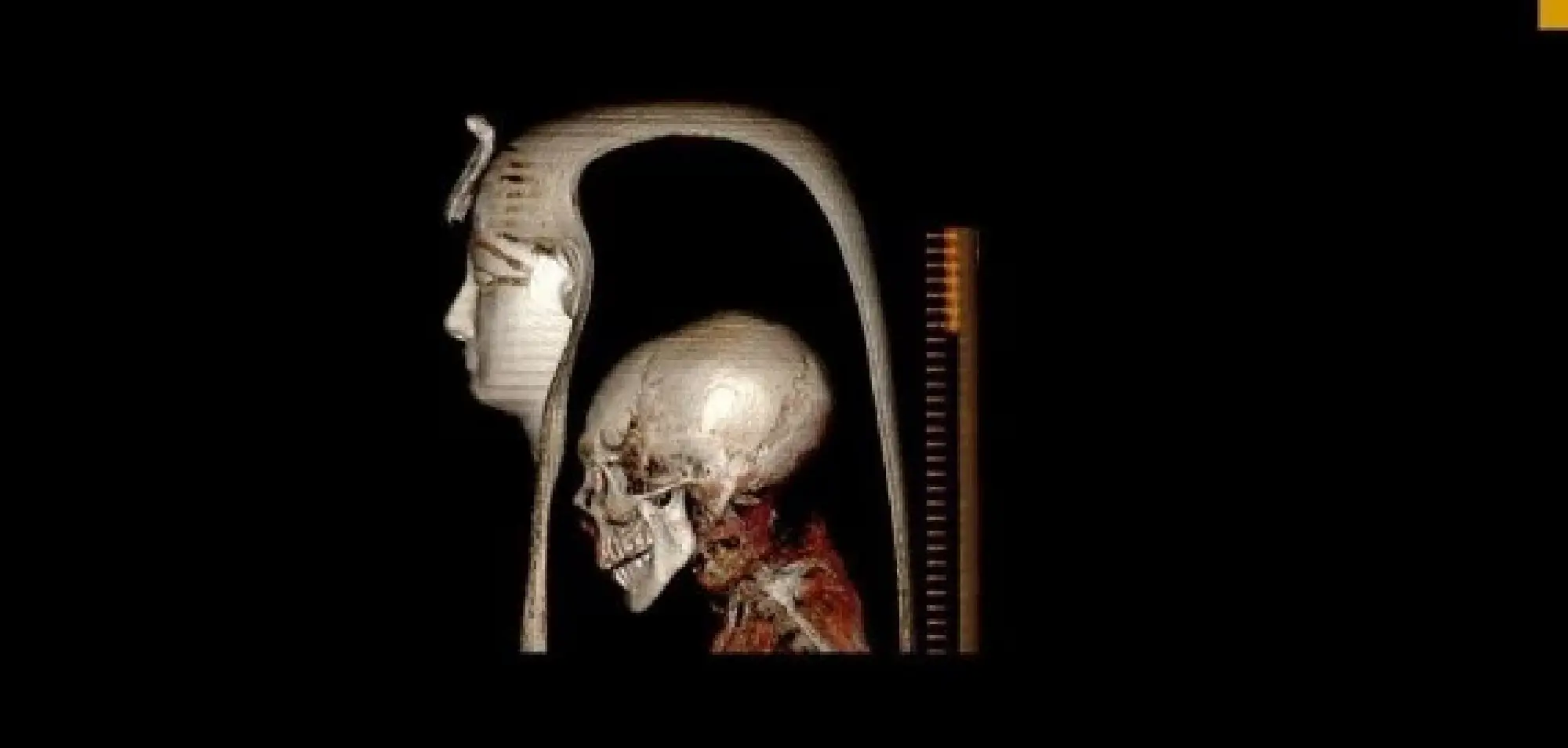 A CT scan shows the skull of Egyptian Pharaoh Amenhotep I and its outer face mask. Egyptian researchers have "digitally unwrapped" the mummy of King Amenhotep I for the first time, revealing many secrets about the pharaoh who ruled Egypt from 1525 to 1504 BC. (Egyptian Ministry of Tourism and Antiquities/Handout via Xinhua)