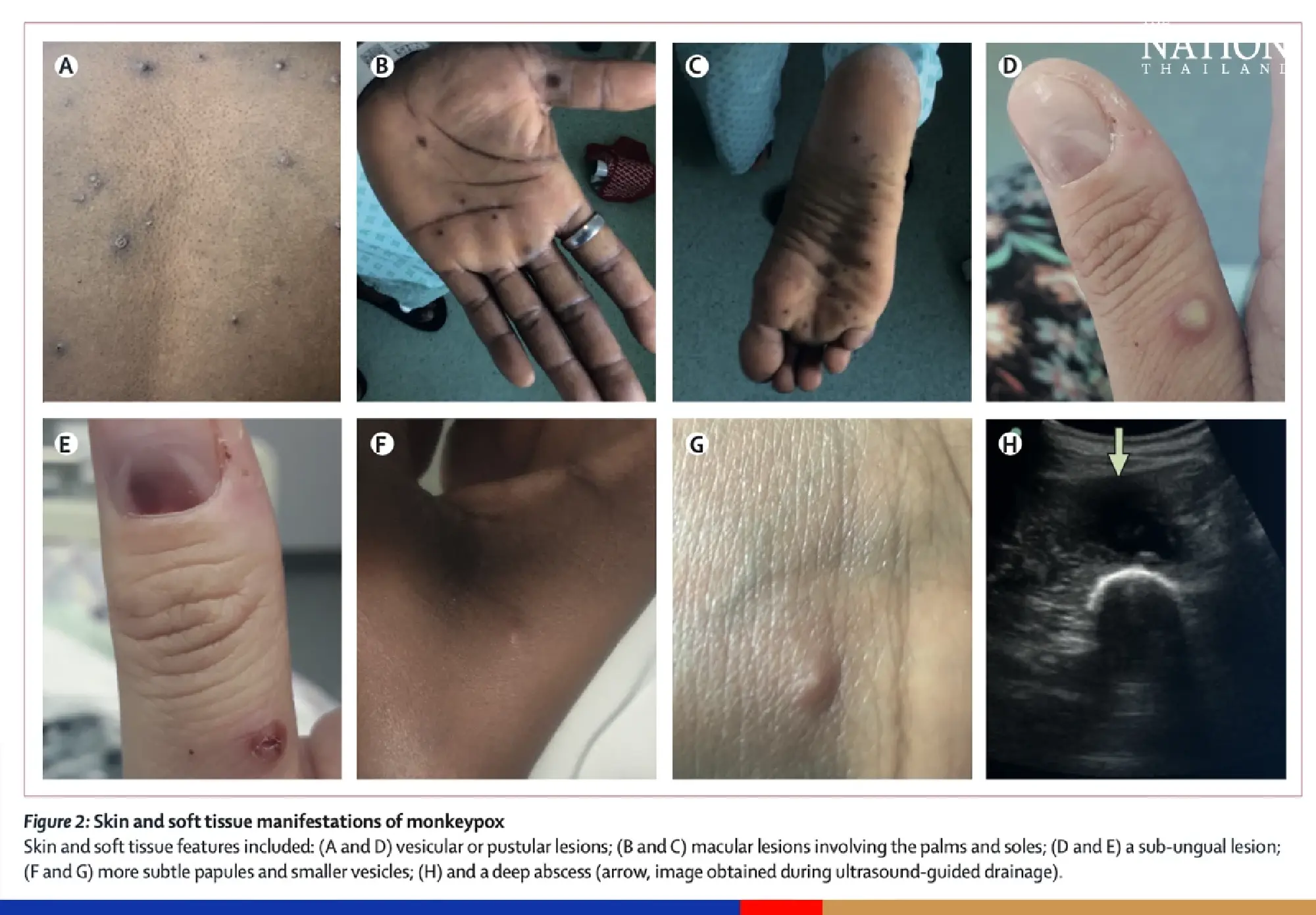 Virologist offers advice on keeping monkeypox at bay