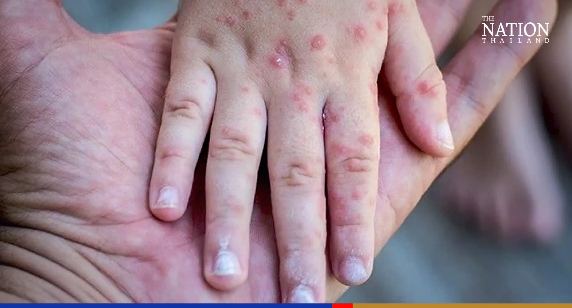 Monkeypox not in ‘dangerous’ category yet, says Public Health Ministry