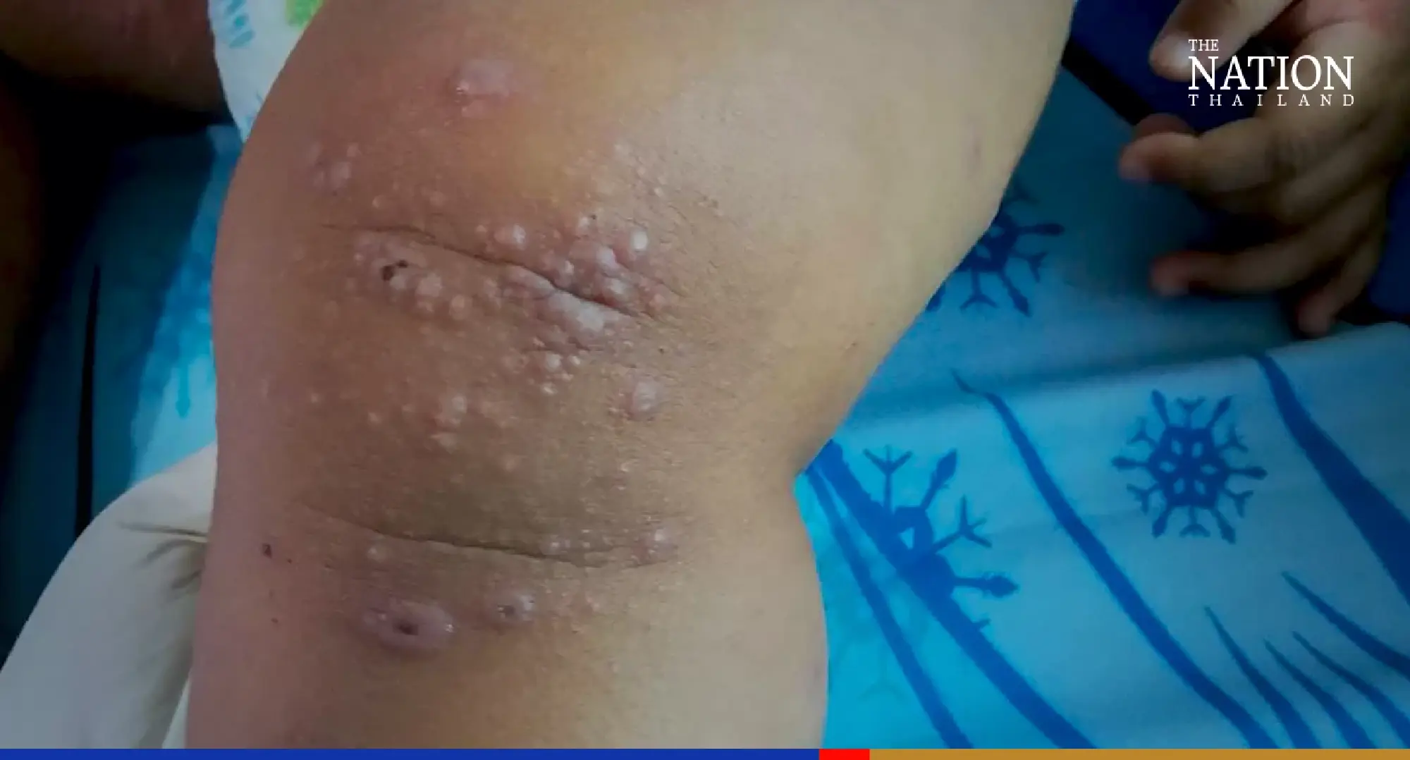 Virologist links ‘tomato flu’ to hand, foot, mouth disease virus