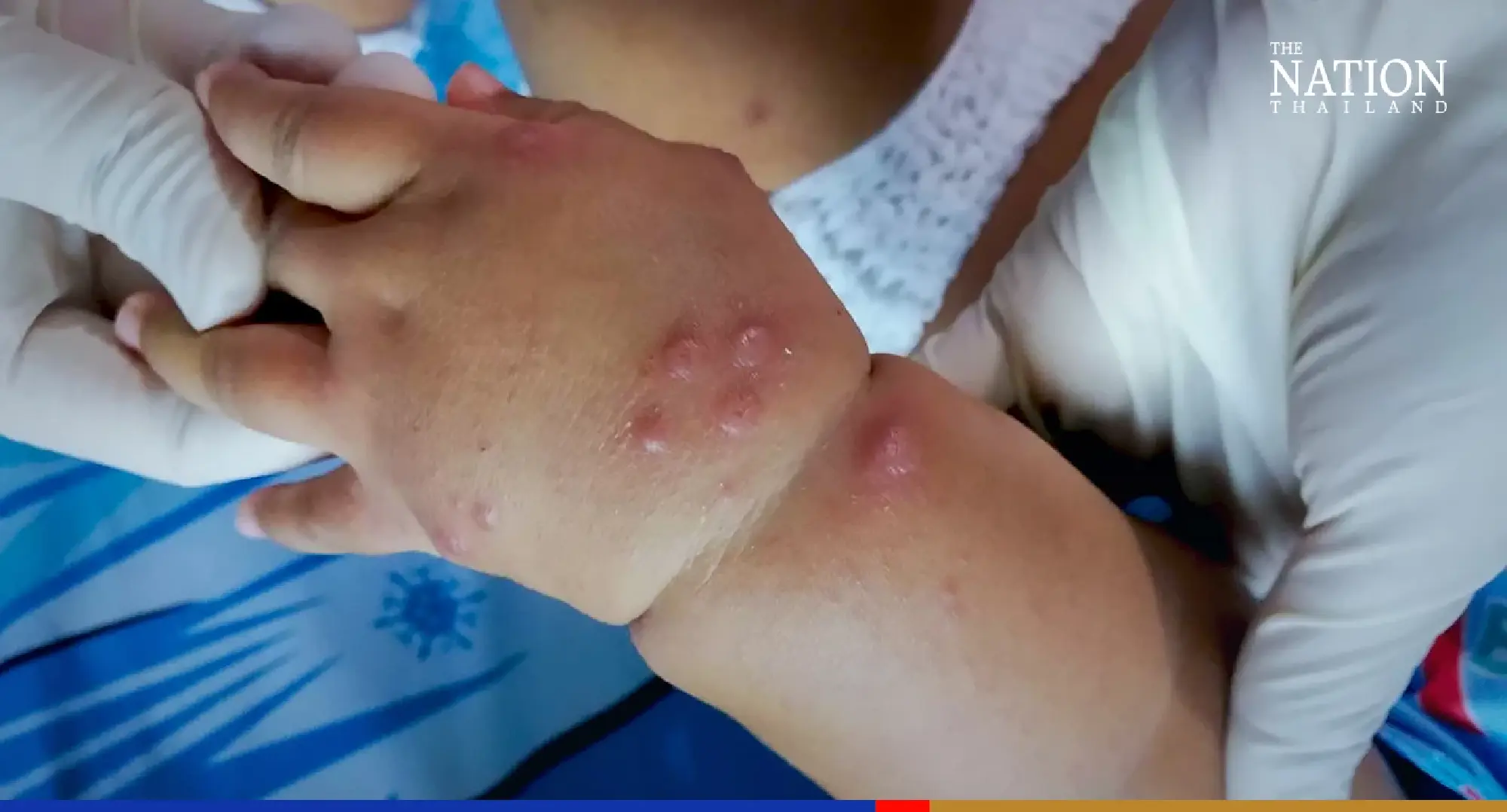 Virologist links ‘tomato flu’ to hand, foot, mouth disease virus