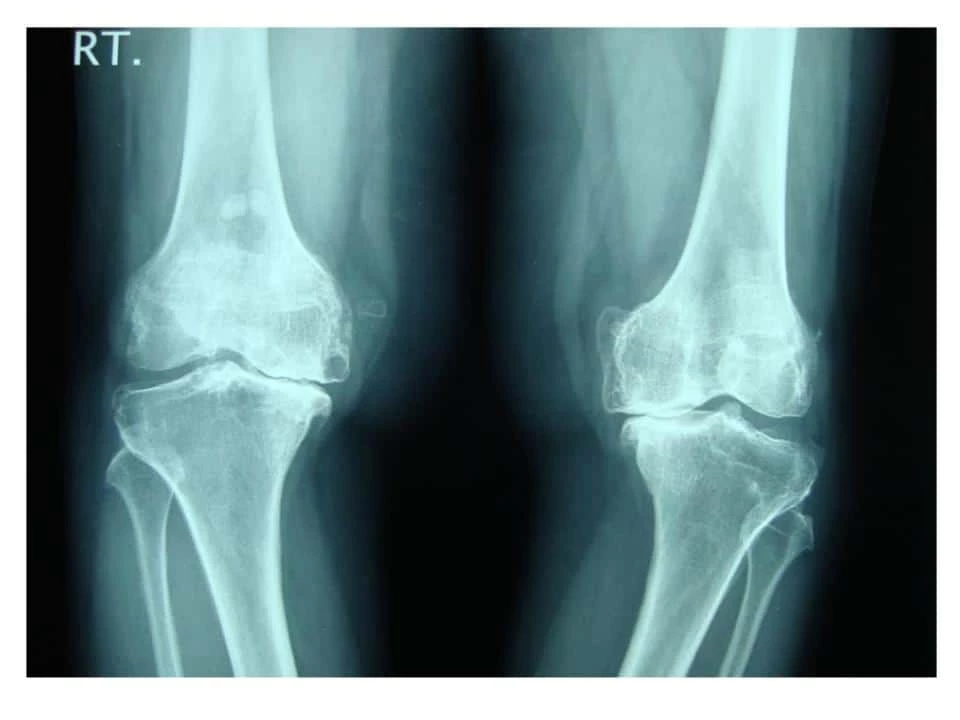Chula Medicine Determines “Cytokines” as Indicator of “Degenerative Joints” 