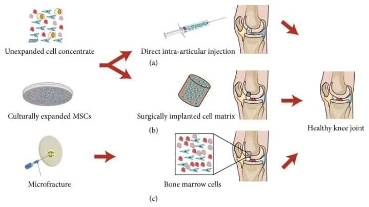 Chula Medicine Determines “Cytokines” as Indicator of “Degenerative Joints” 