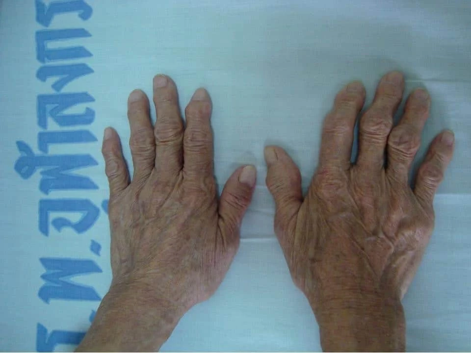 Chula Medicine Determines “Cytokines” as Indicator of “Degenerative Joints” 