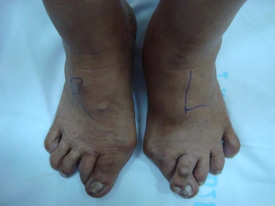 Chula Medicine Determines “Cytokines” as Indicator of “Degenerative Joints” 