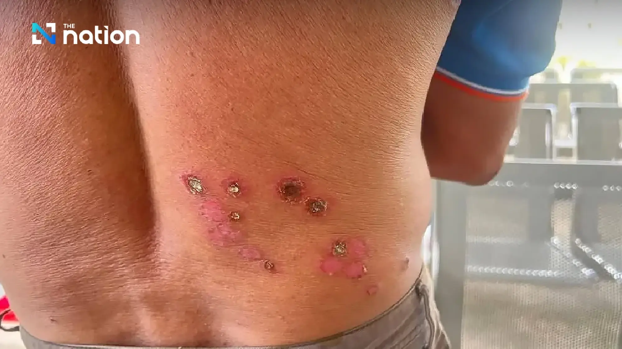 Anthrax suspected in Nong Bua Lamphu; Urgent contact tracing launched