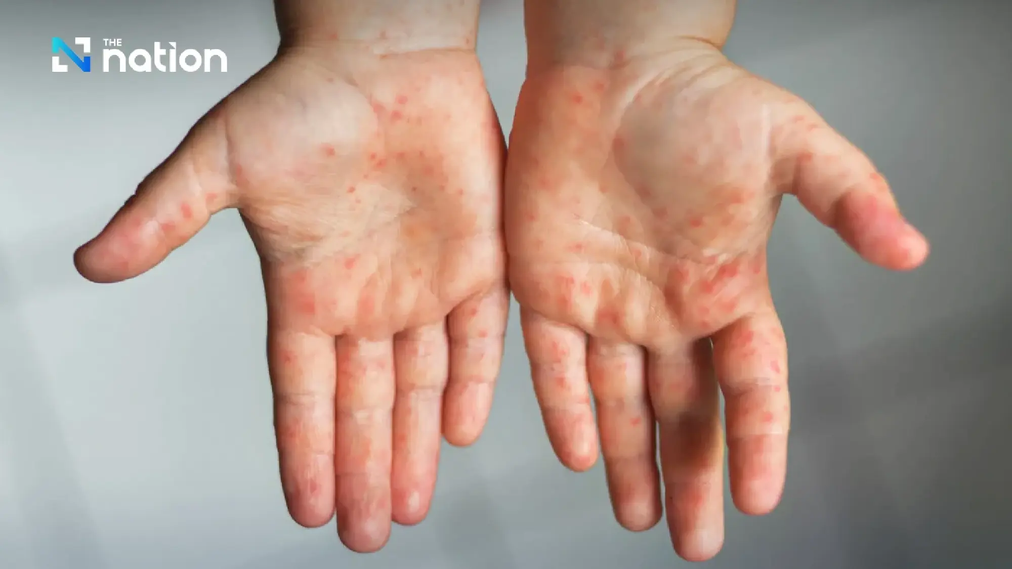 Thailand warns of hand, foot and mouth disease outbreak