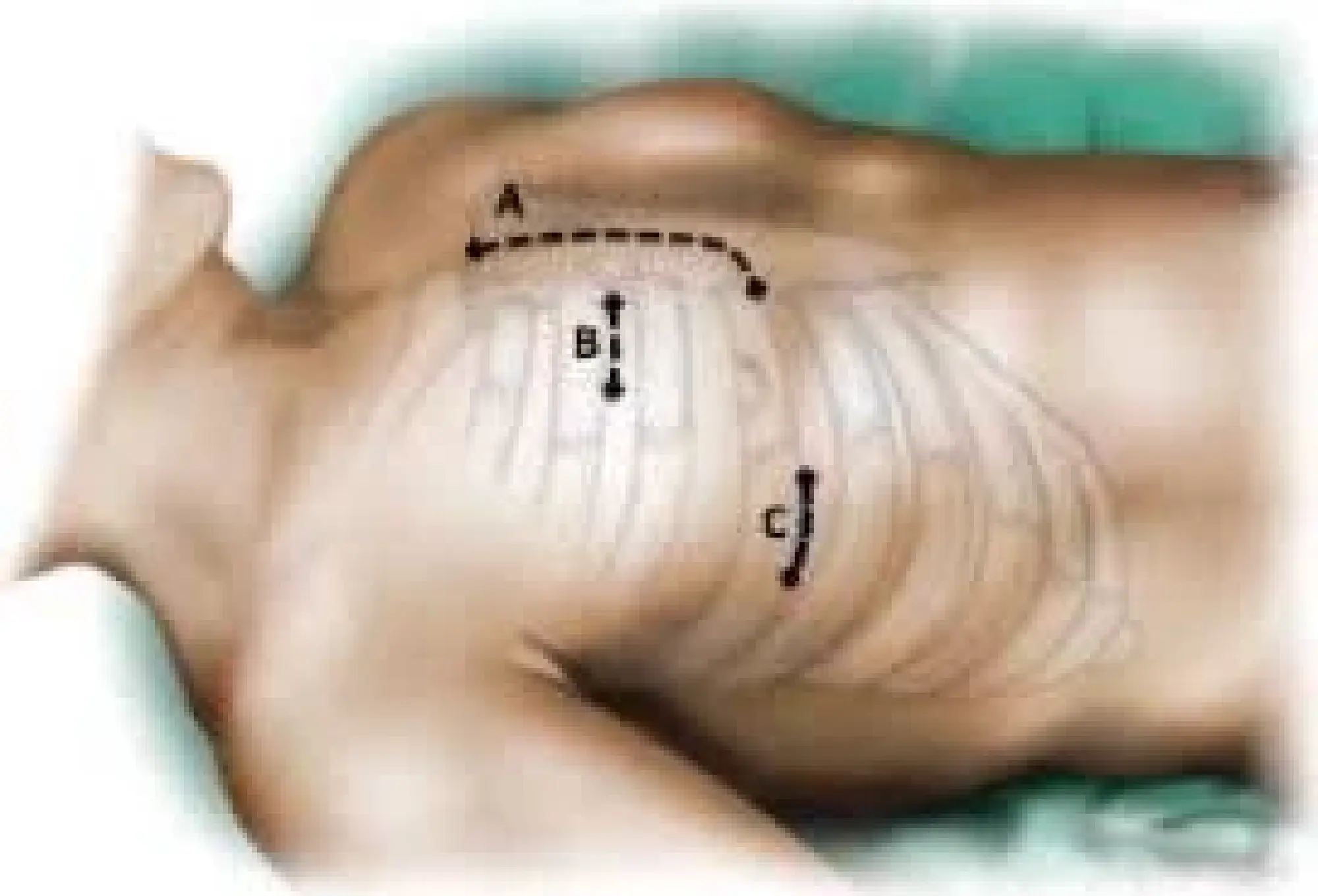 Minimally Invasive Heart Surgery: A New Era in Valve Disease Treatment Offering Reduced Burden, Faster Recovery, and Enhanced Quality of Life