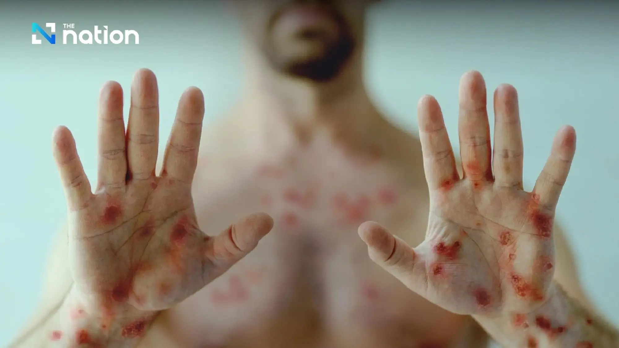 Thailand reports 40 monkeypox cases in 2025, urges high-risk groups to practise safe sex