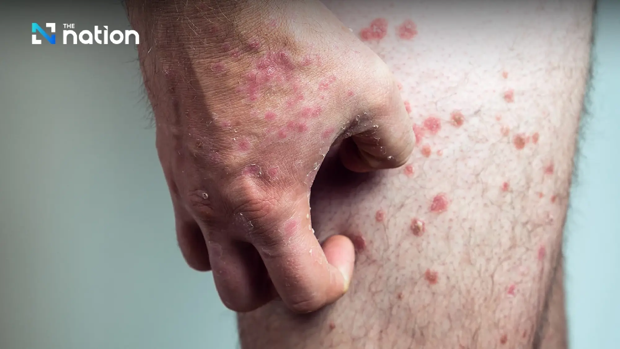 Thailand reports 40 monkeypox cases in 2025, urges high-risk groups to practise safe sex