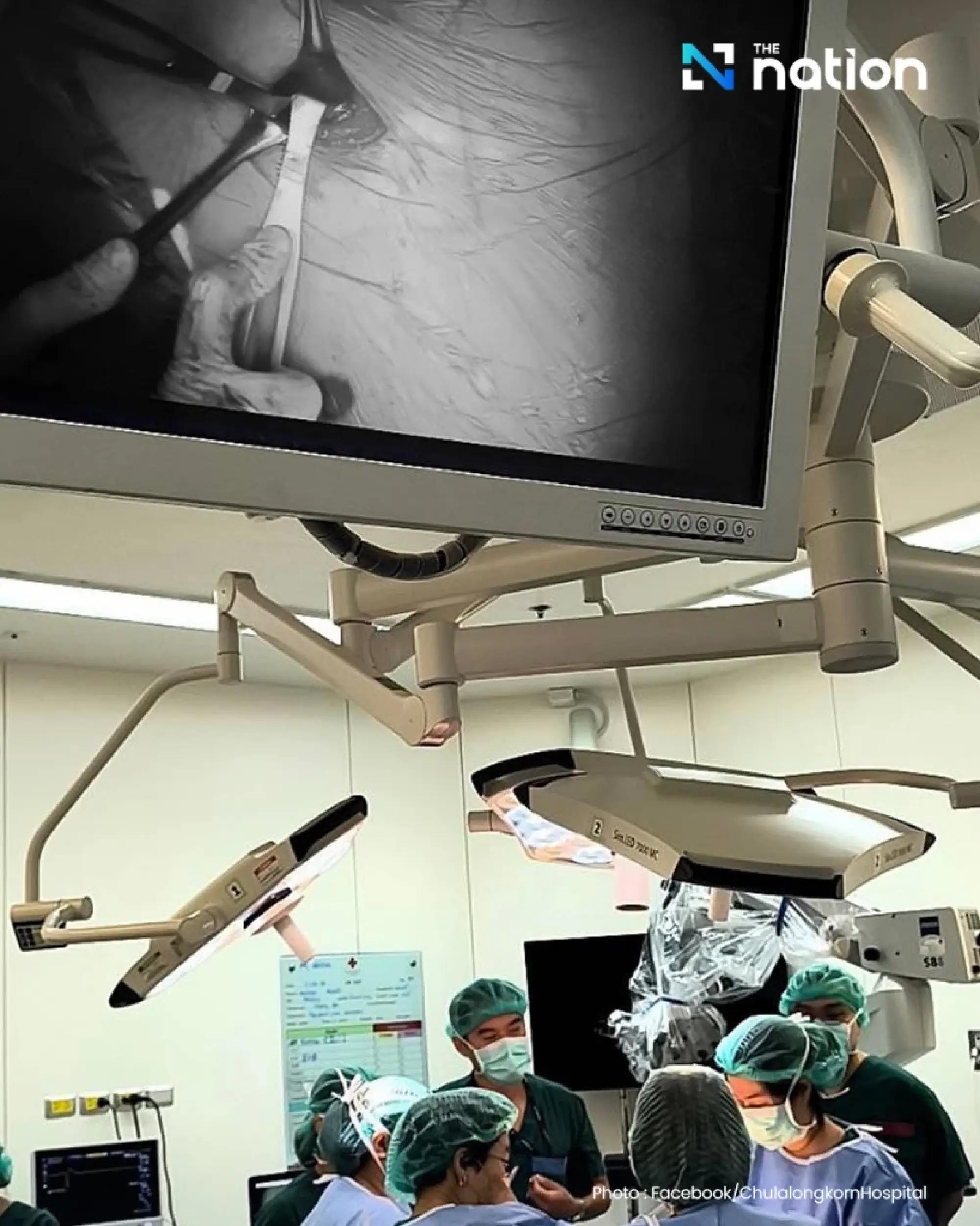 Chulalongkorn Hospital succeeds with first HGNS surgery in Thailand for sleep apnea