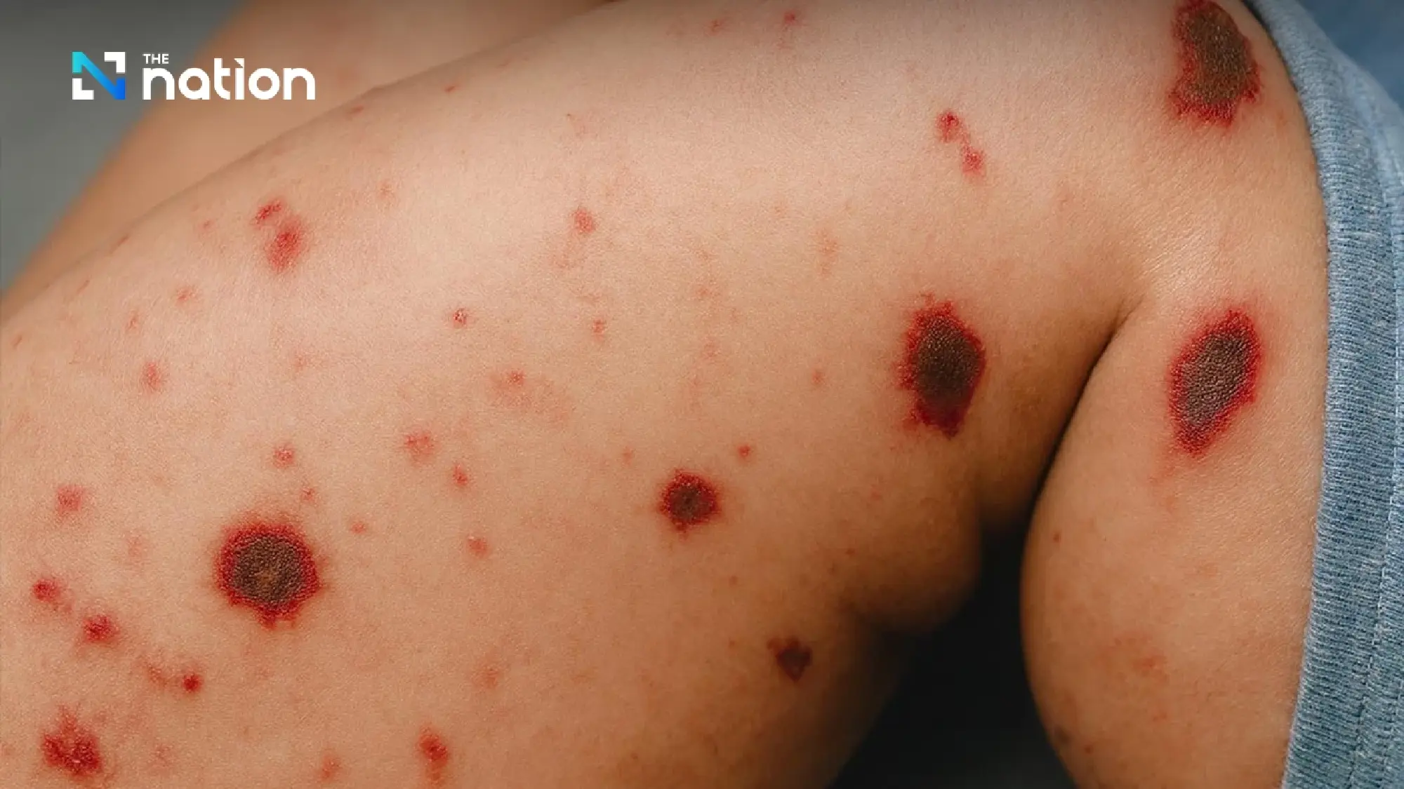 DDC urges travellers to the UK to get meningococcal vaccine before departure