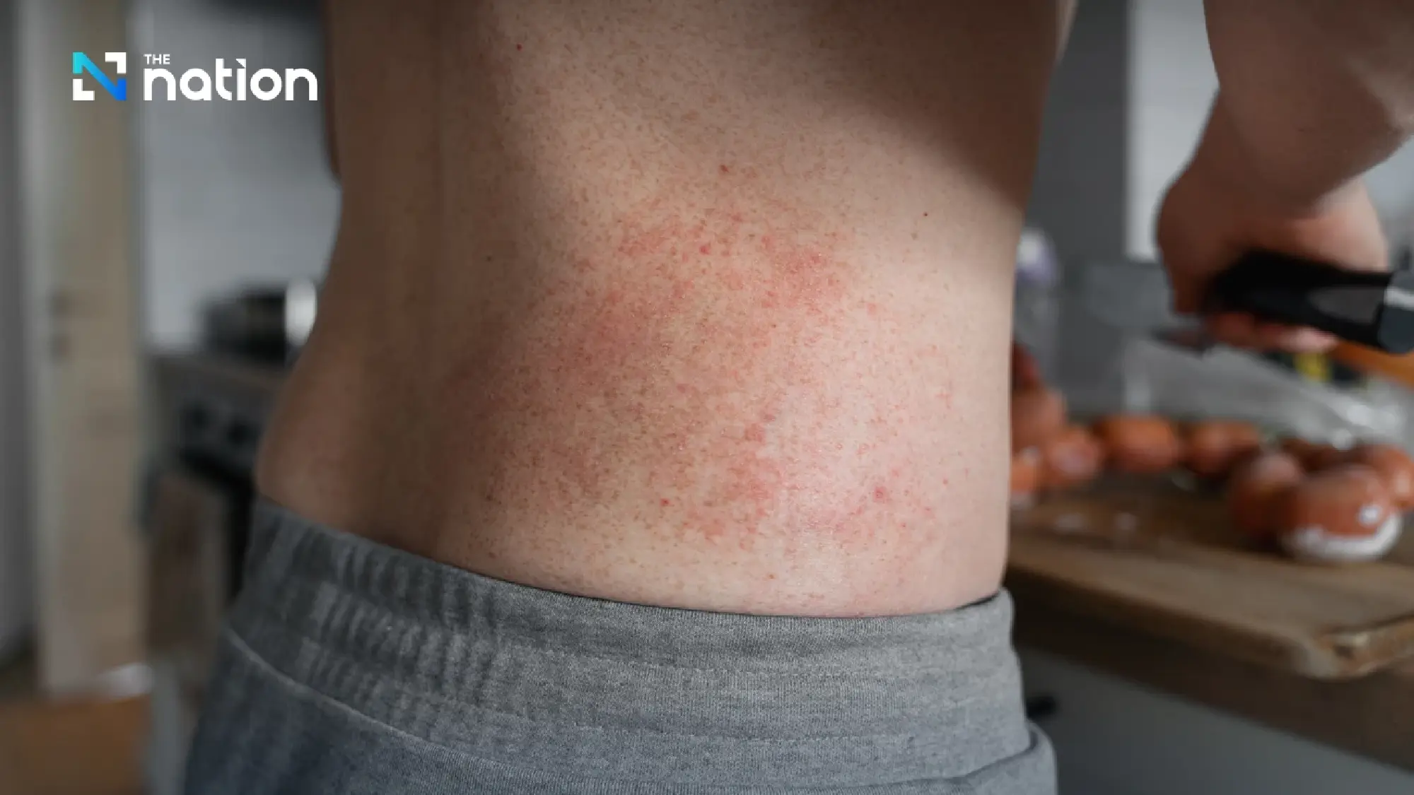 UK meningococcal outbreak raises alarm after two deaths