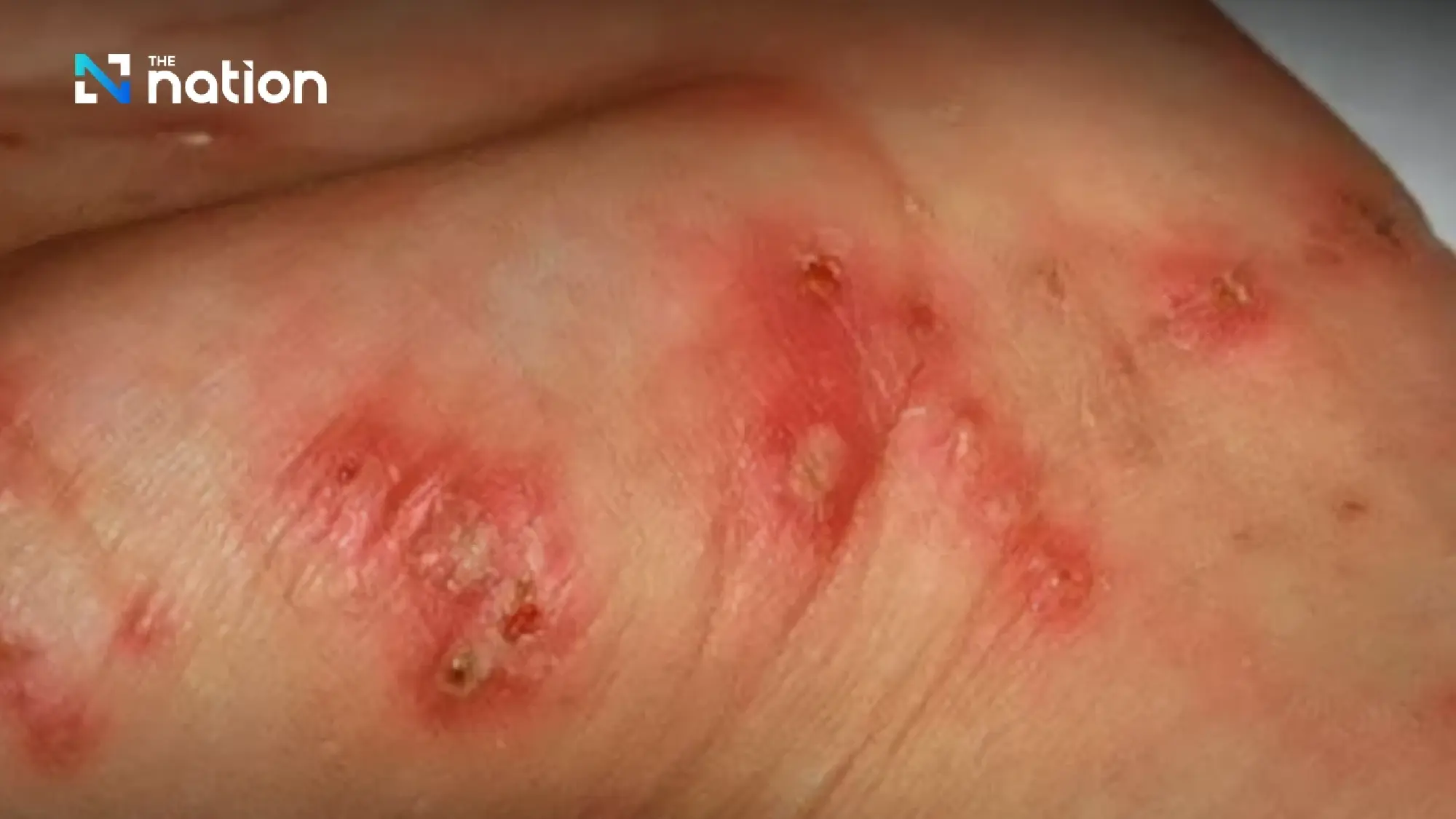 Thai Government Warns of Deadly 'Soil Fever' Outbreak as Fatalities Rise