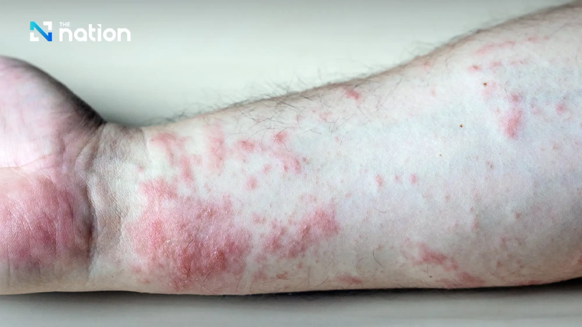 Thailand steps up mpox clade Ib surveillance after two new cases