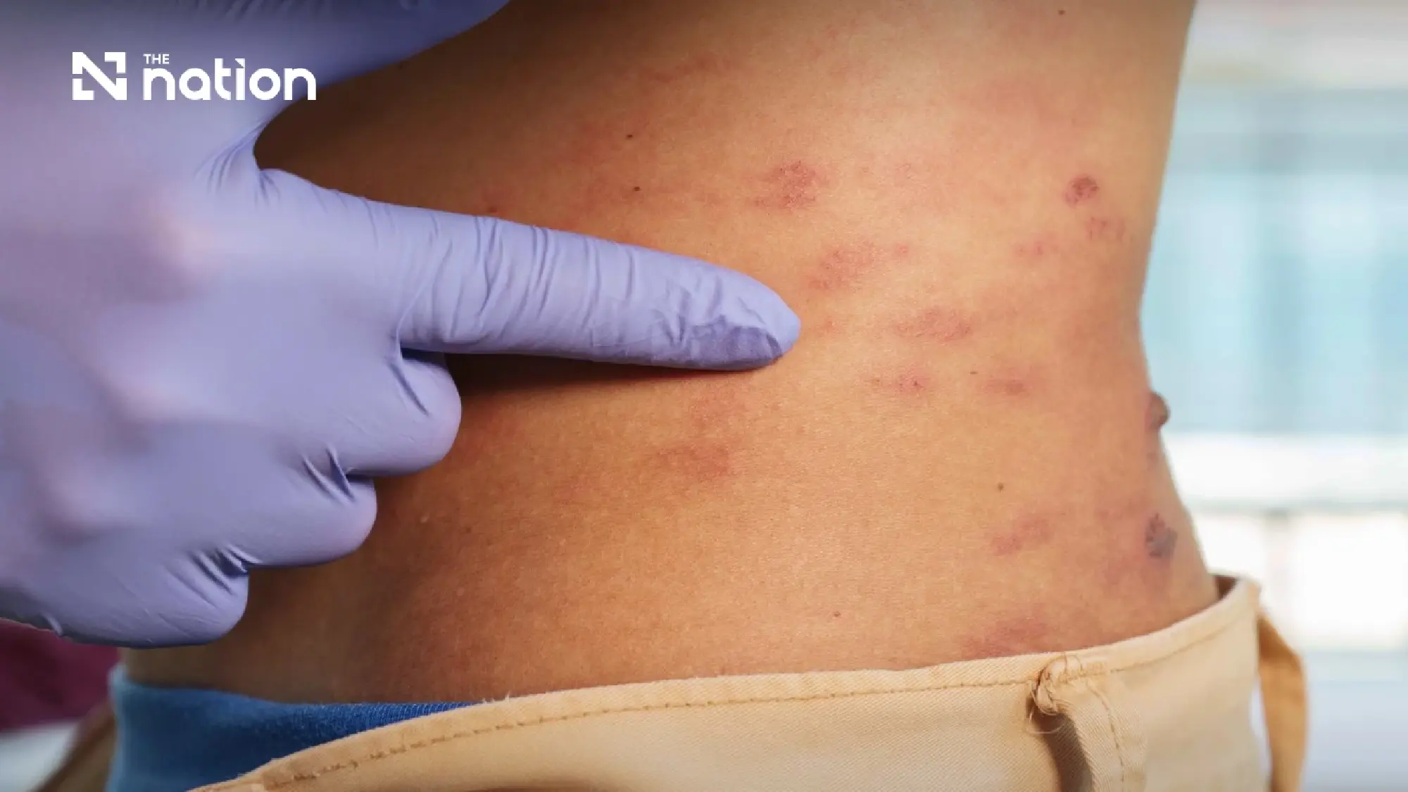 Thailand moves to add four diseases to national surveillance list