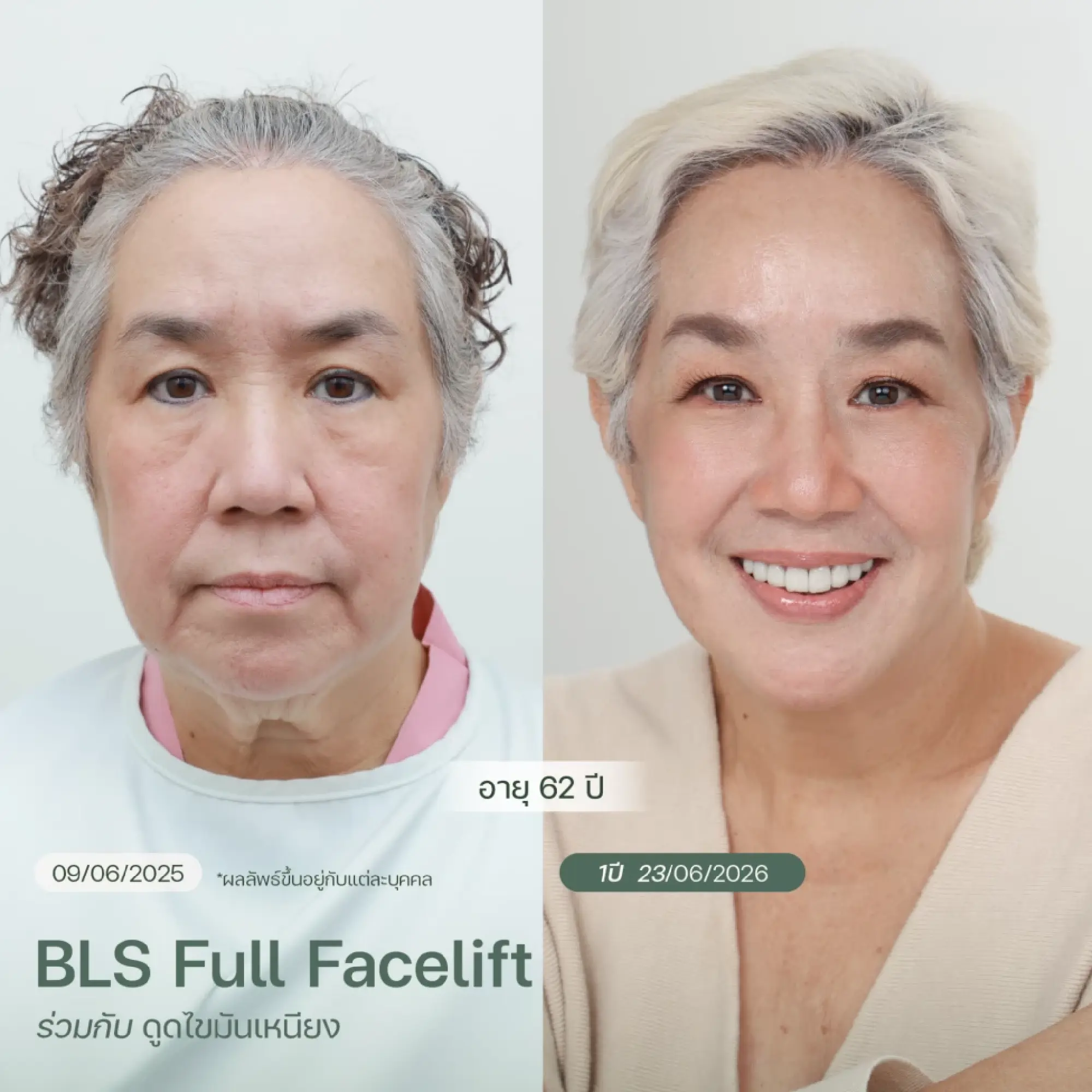 Results of the BLS Full Facelift Program Combined with Double Chin Fat Reduction