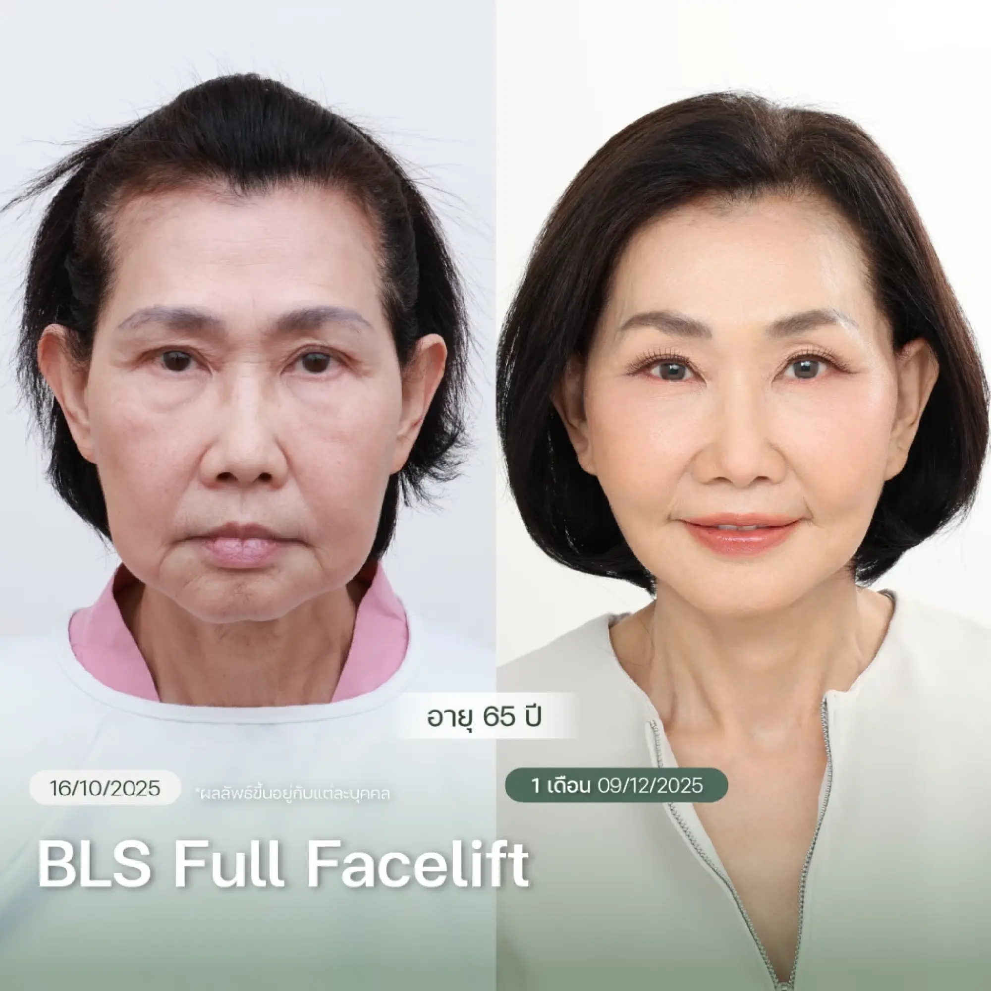 Results of the BLS Full Facelift Program
