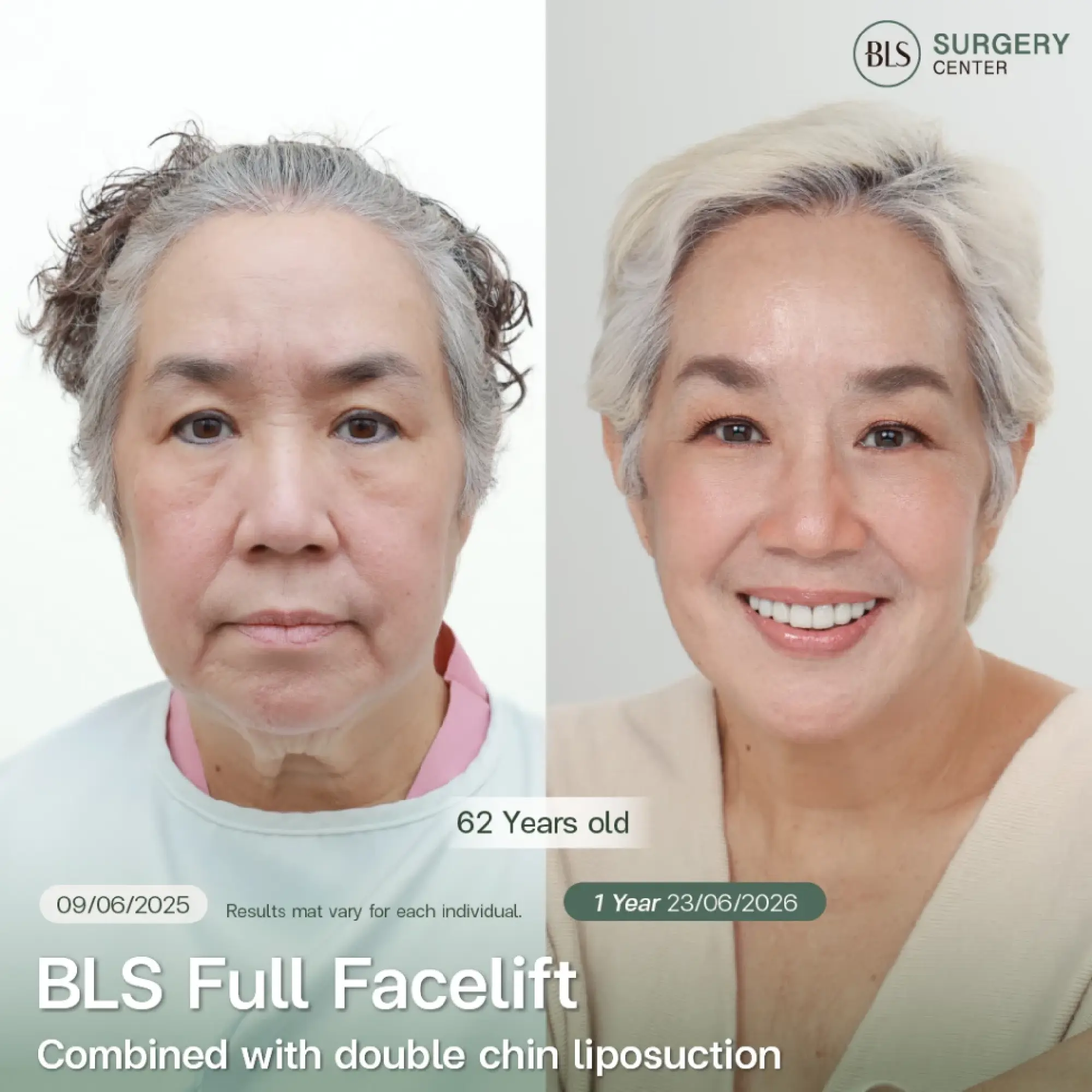Results of the BLS Full Facelift Program Combined with Double Chin Fat Reduction
