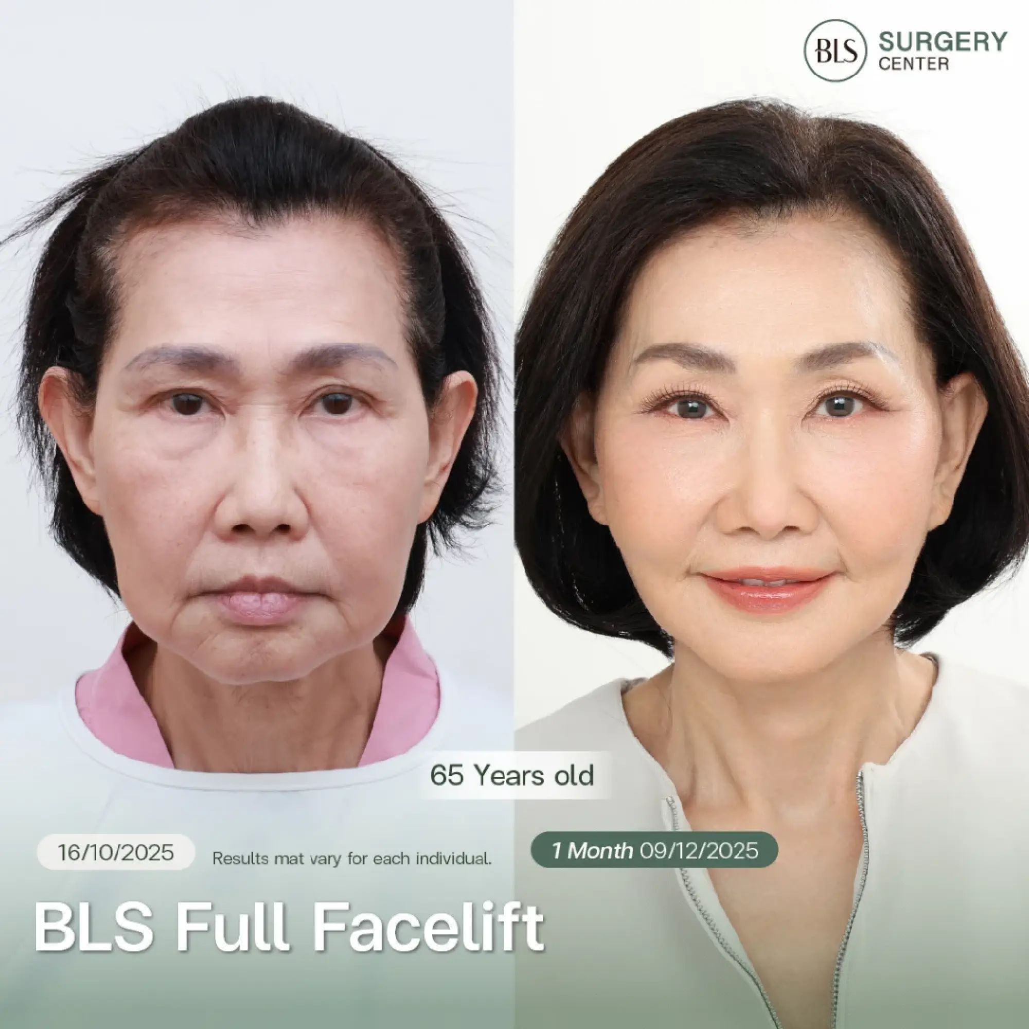 Results of the BLS Full Facelift Program