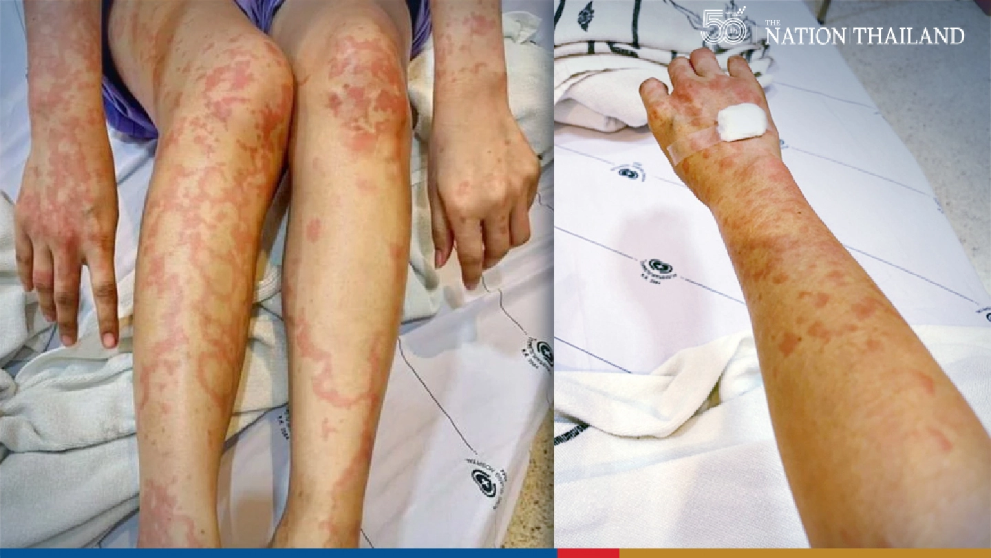 Patient to sue woman for using her photo to claim allergy after Sinovac jab Patient to sue woman for using her photo to claim allergy after Sinovac jab