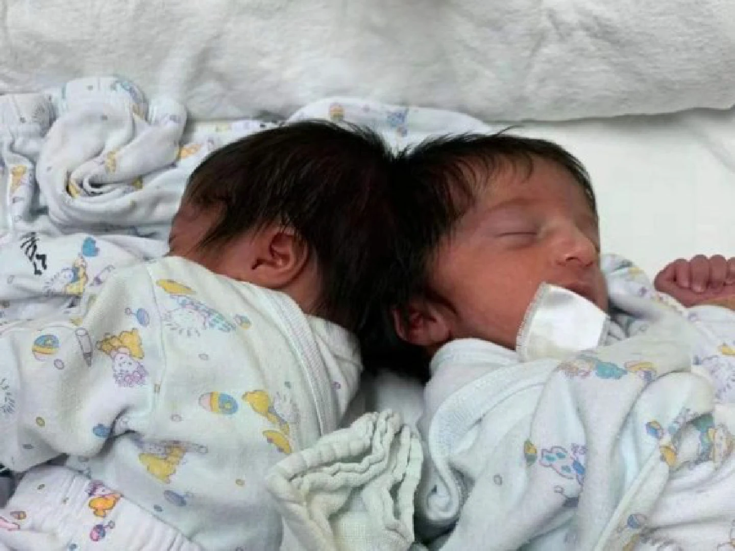 Israeli hospital separates head-connected baby twins in rare operation