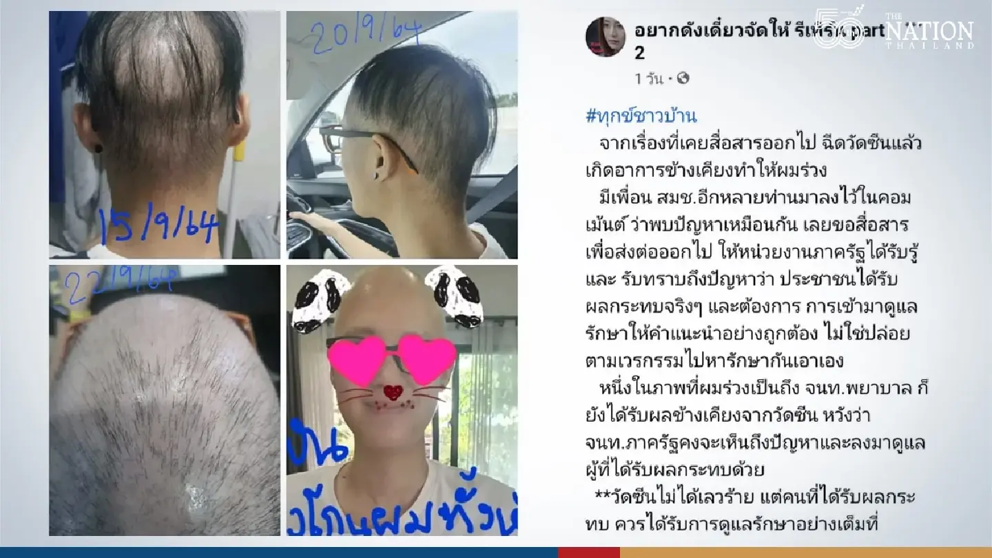 Facebook page launches campaign over complaints of severe hair loss from Covid jabs
